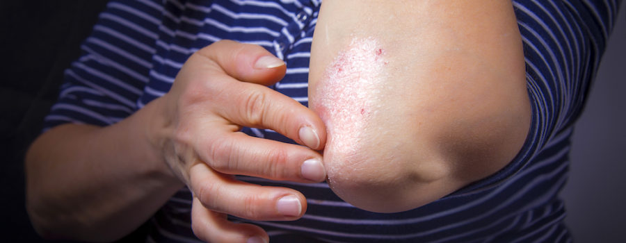 Skin Disorder Can Be Associated With All Vascular Disease